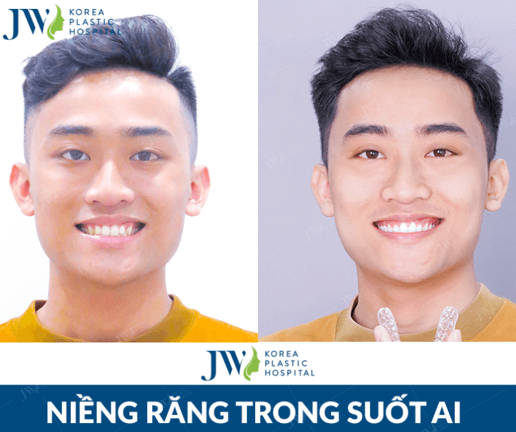 Niềng răng 3D Clear và niềng răng trong suốt AI