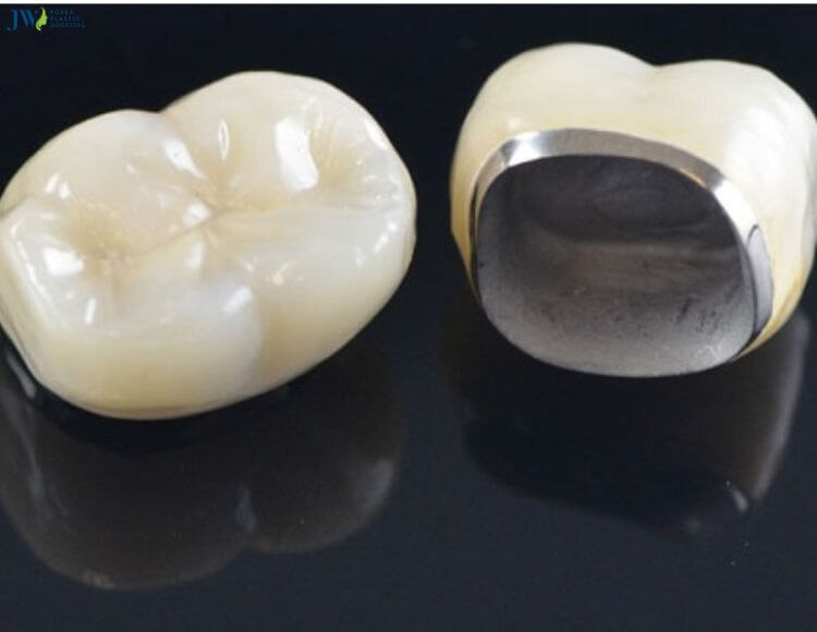 Bọc sứ toàn hàm có mấy loại và chi phí như thế nào? 2