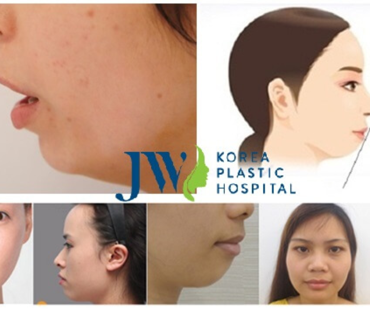 Niềng răng có làm cằm bớt lẹm không
