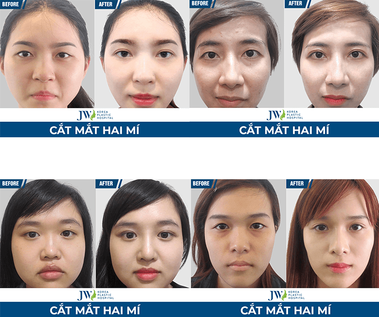 Cắt mắt hai mí