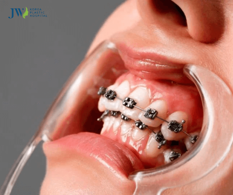 dấu hiệu khi mới niềng răng