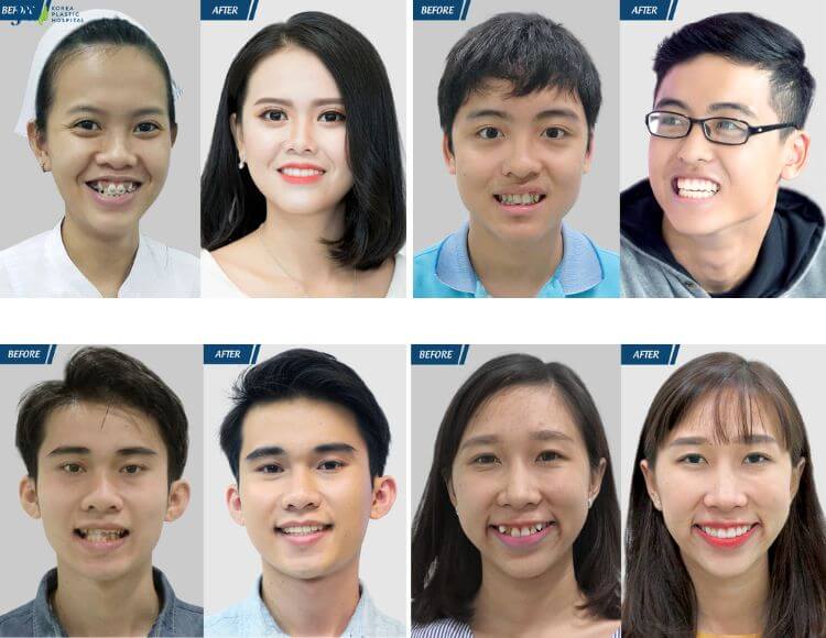 Kết quả điều trị niềng răng tại JW