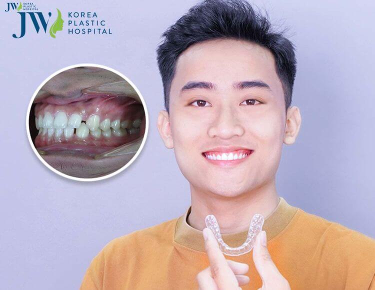 Kết quả niềng răng AI