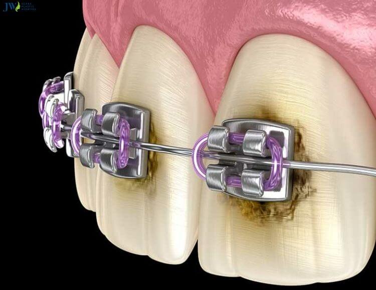 Mách bạn 7 bí quyết vệ sinh răng miệng khi niềng chuẩn nha khoa 1