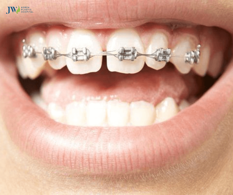 Niềng răng trong suốt 1 hàm