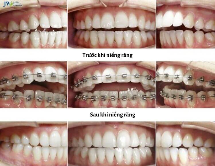 Niềng răng chỉnh khớp cắn