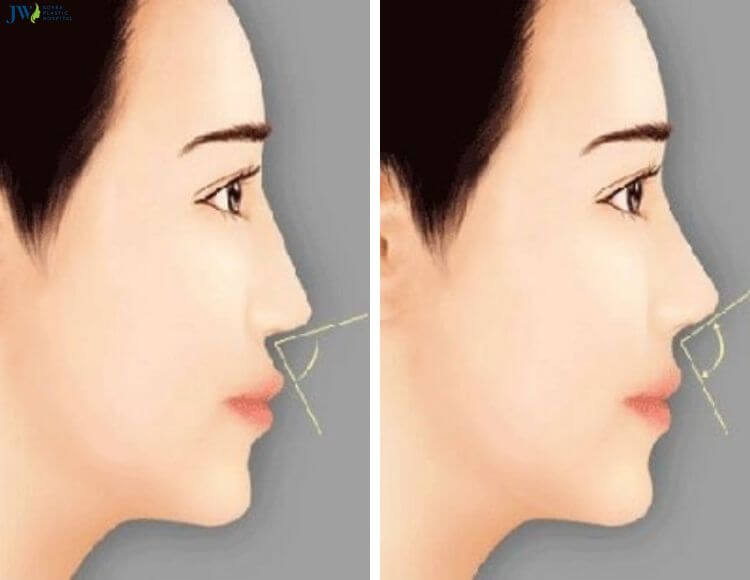 Niềng răng giúp mũi trông cao hơn