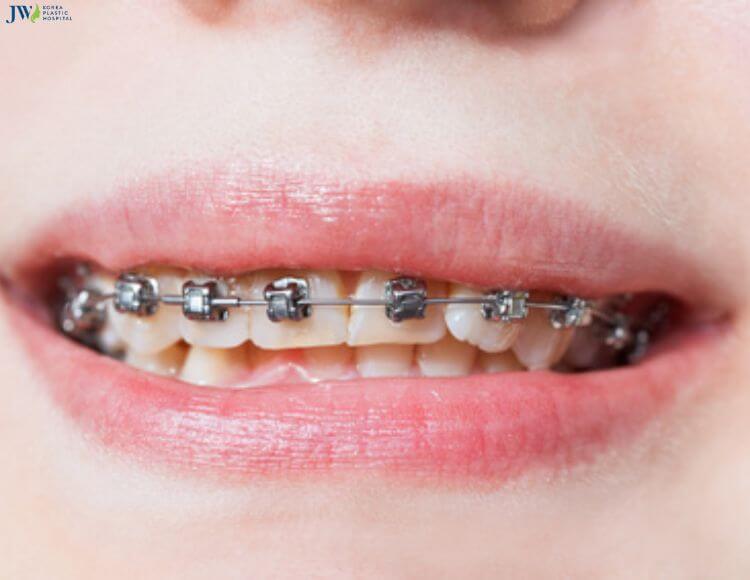 Niềng răng mắc cài tự buộc tiết kiệm thời gian thăm khám