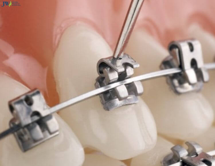 Niềng răng mắc cài tự buộc