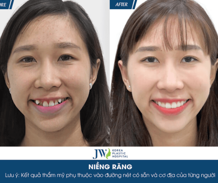 Niềng răng mặt Vline