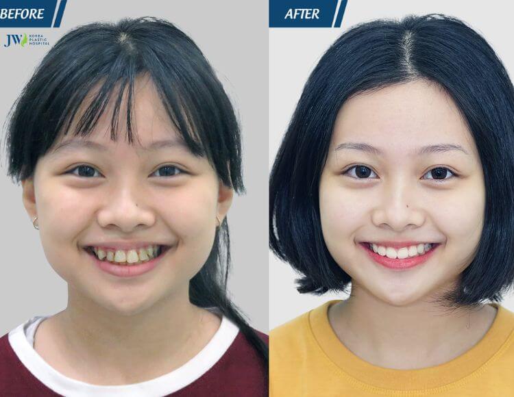 Niềng răng ở độ tuổi phát triển có thể giúp xương hàm thay đổi phần nhỏ