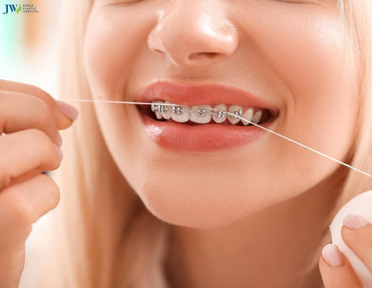 16 tuổi chi phí niềng răng