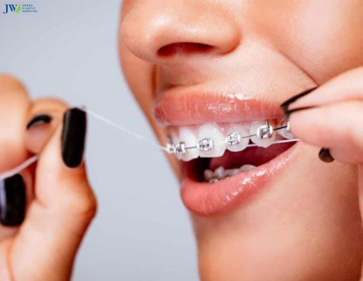 Tại sao niềng răng lại gây ê buốc răng? Cách điều trị tại nhà? 3