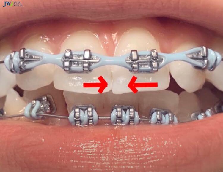 Tất tần tật về các loại thun phổ biến nhất trong niềng răng! 2