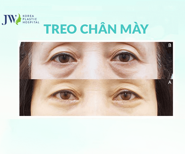 Treo chân mày