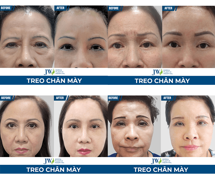 Treo chân mày