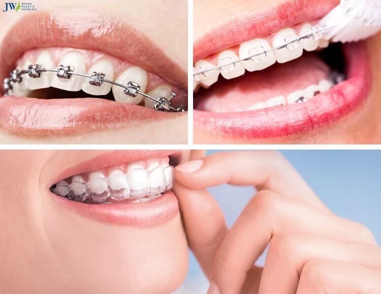 Các loại niềng răng