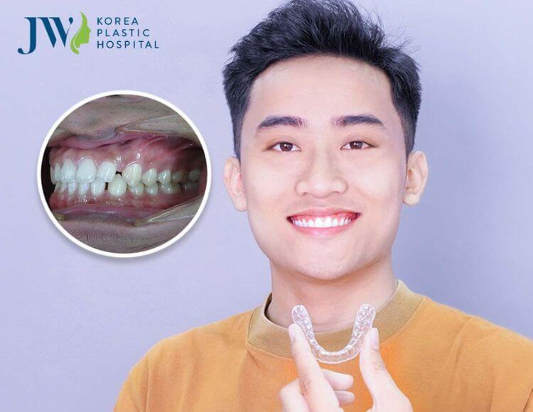 Thay đổi sau khi niềng răng
