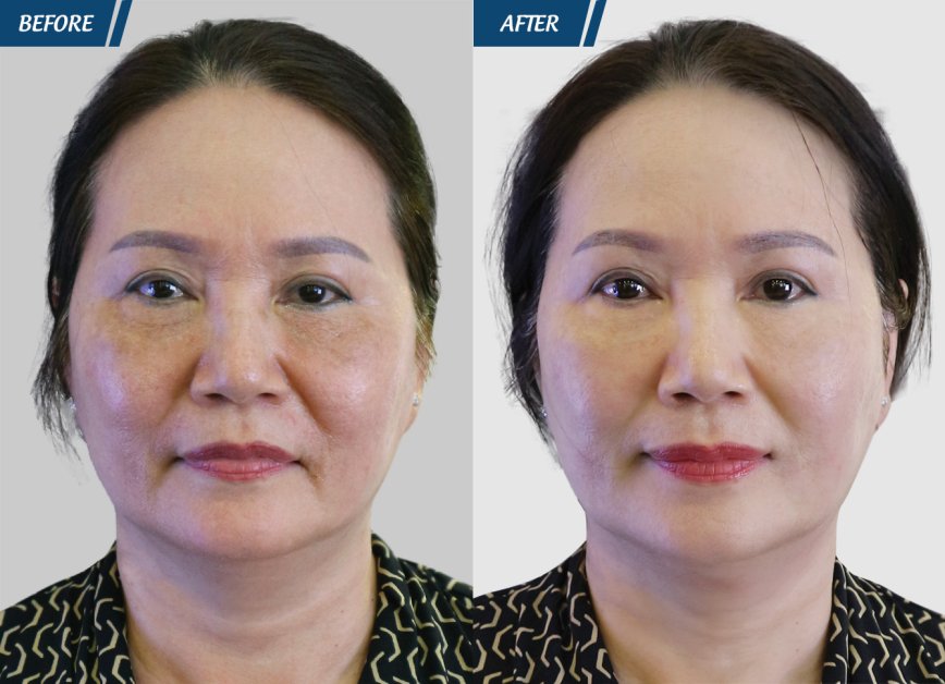 điều trị tàn nhang