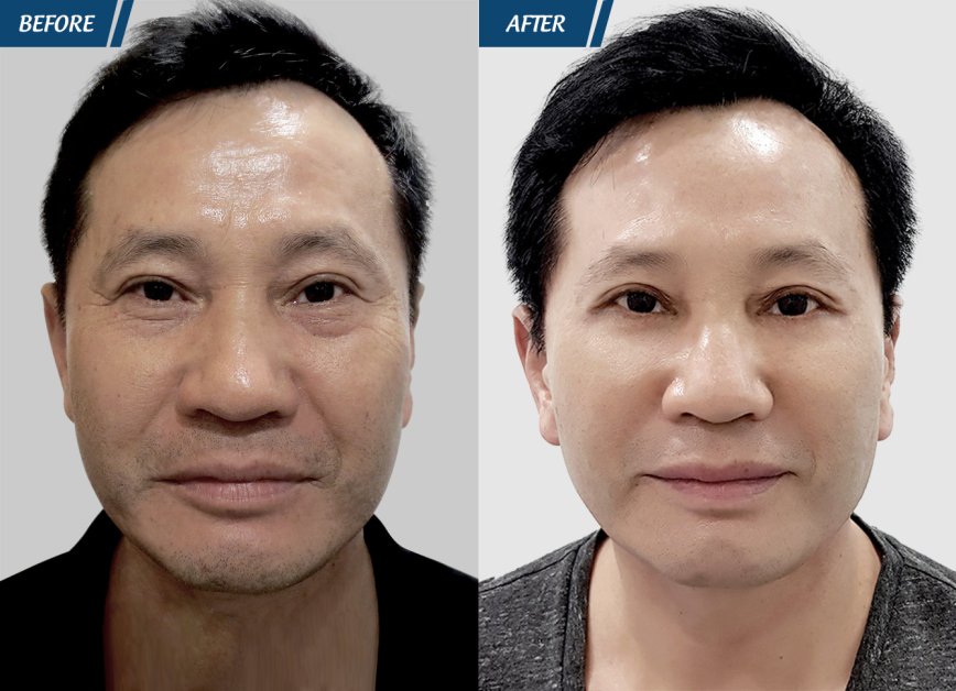 điều trị tàn nhang