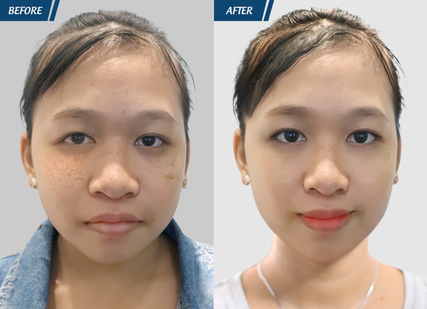 điều trị tàn nhang