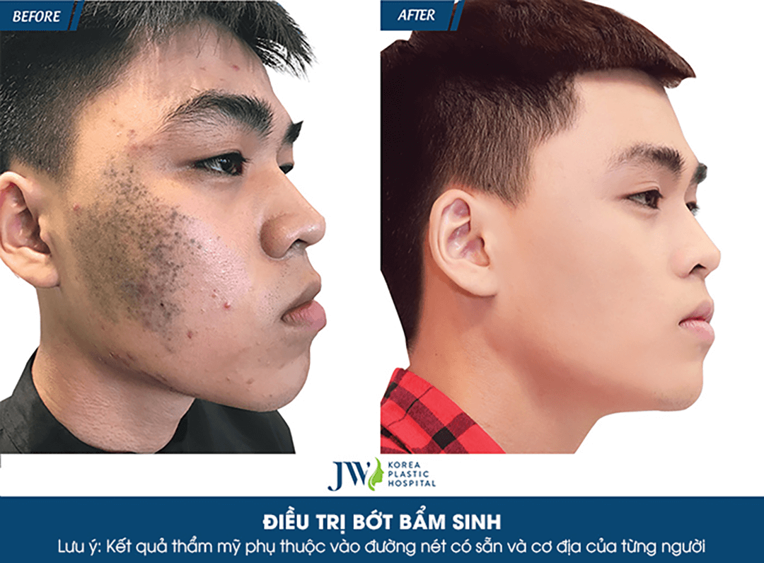 Công nghệ 3S Plus điều trị bớt OTA