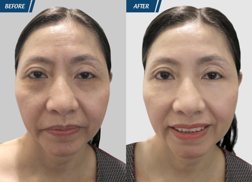 trẻ hoa da ultherapy