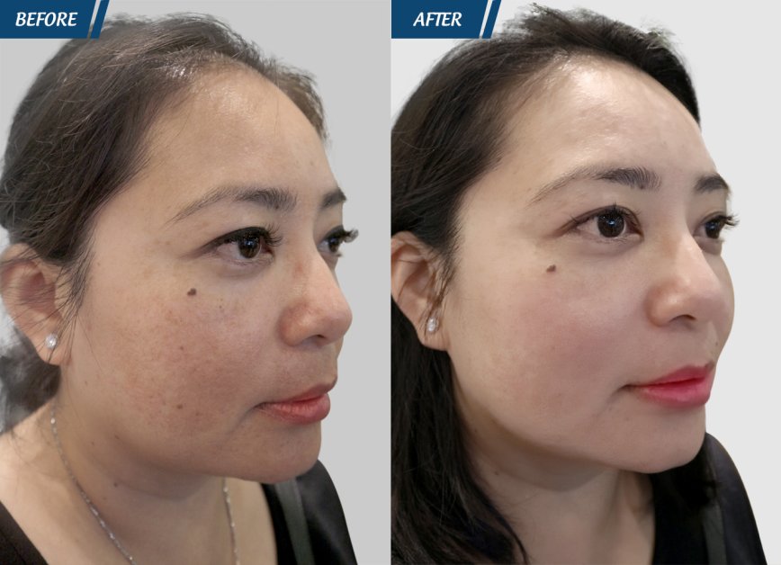 trẻ hóa da ultherapy