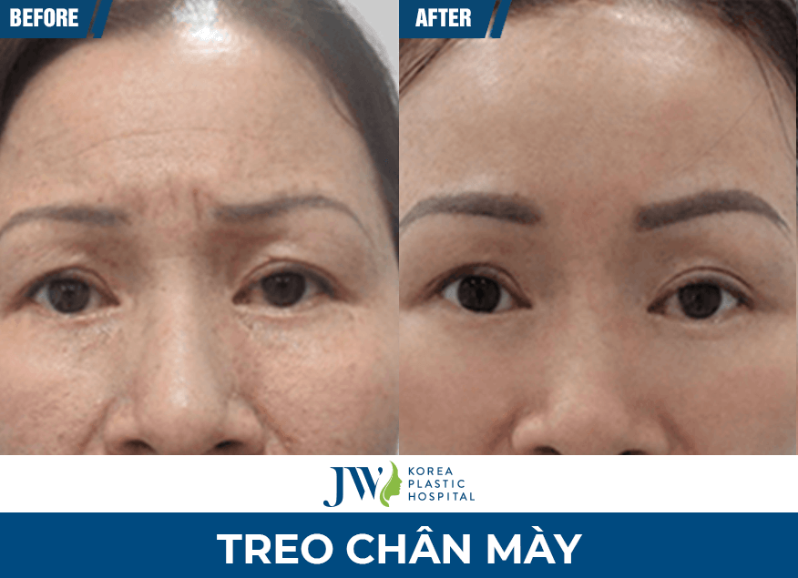 treo chân mày