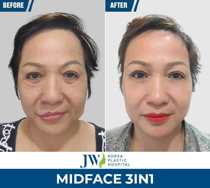 midface-3in1