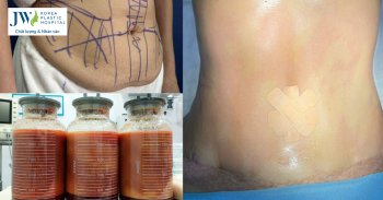 nâng ngực và hút mỡ bụng