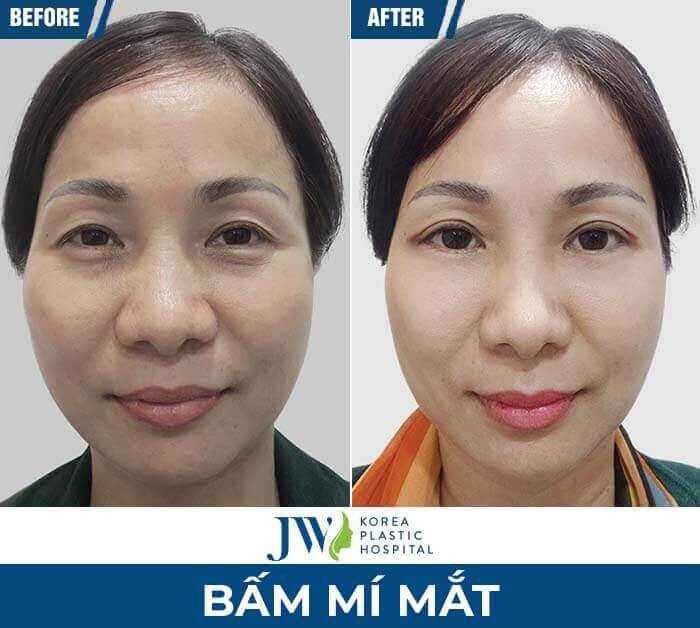 mắt 1 mí