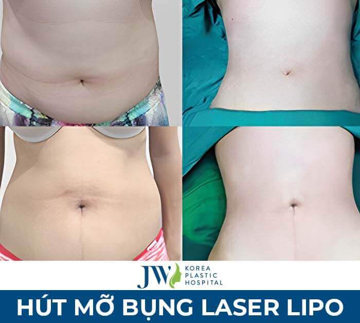 hút mỡ bụng