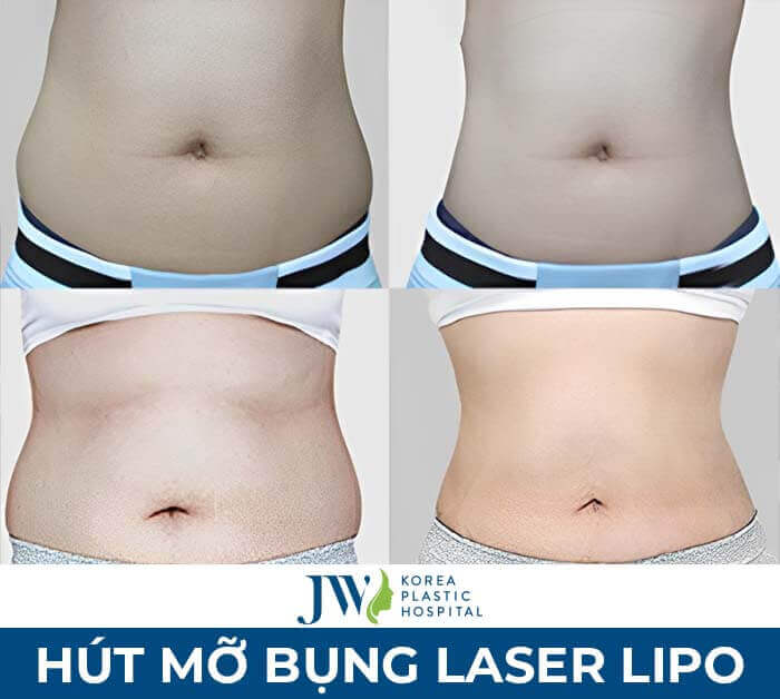 hút mỡ bụng