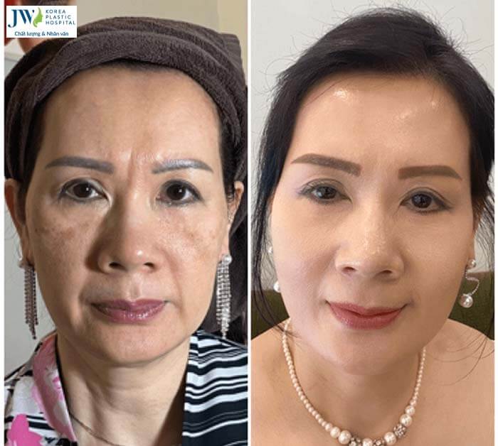 Thẩm mỹ không xâm lấn