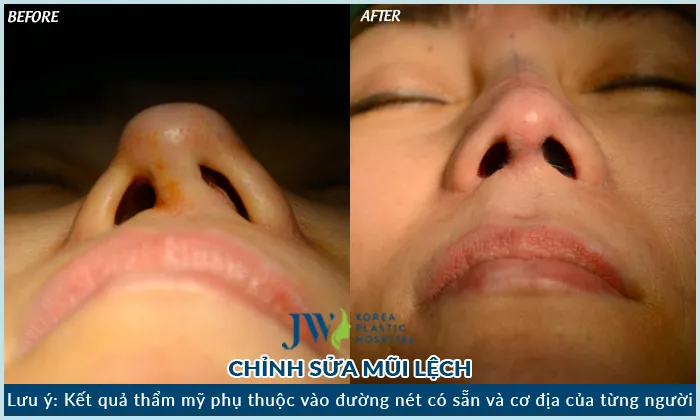 Sửa mũi hỏng