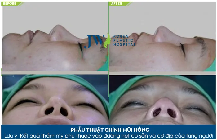 Sửa mũi hỏng