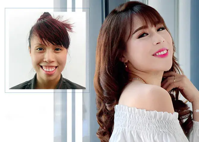 Before and after double jaw surgery