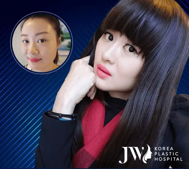 Before and after S line Plus Rhinoplasty