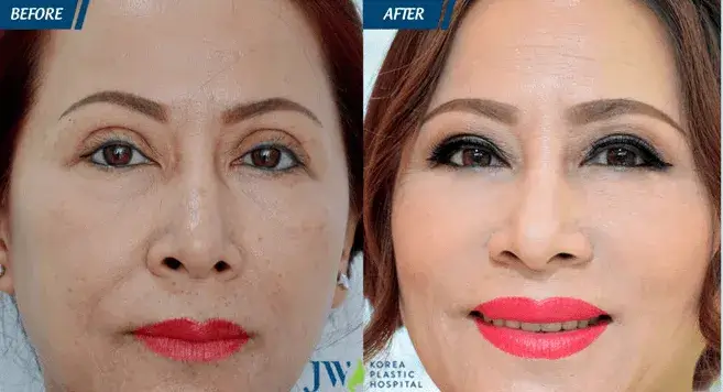 Before and after revision eye surgery