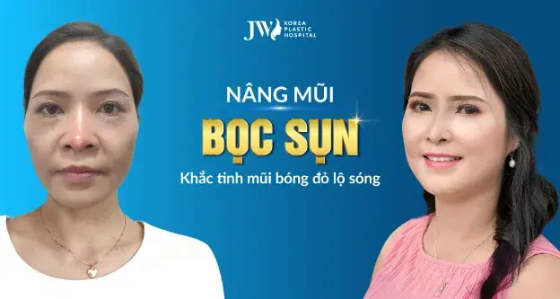 nâng mũi bọc sụn