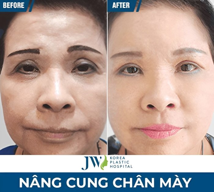 nâng cung chân mày