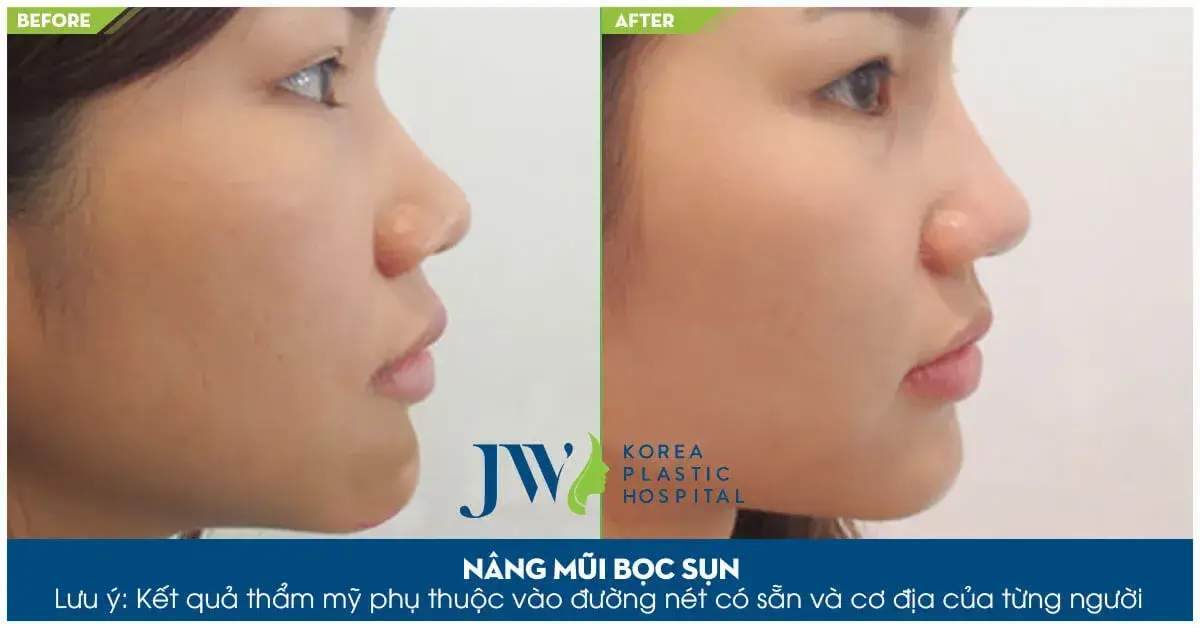 nâng mũi bọc sụn