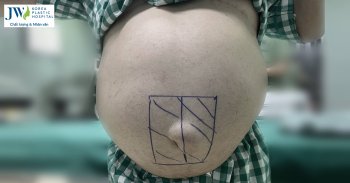 thoát vị rốn