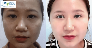 Mắt baby