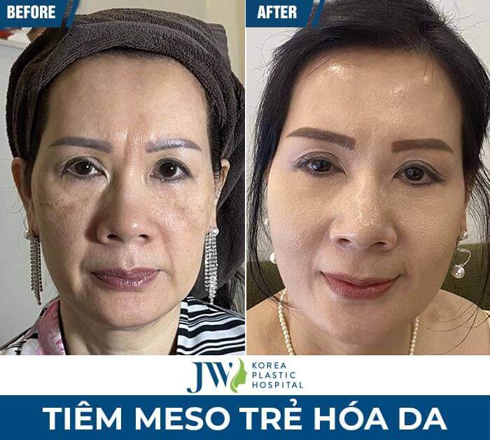 meso-tre-hoa-da-jw