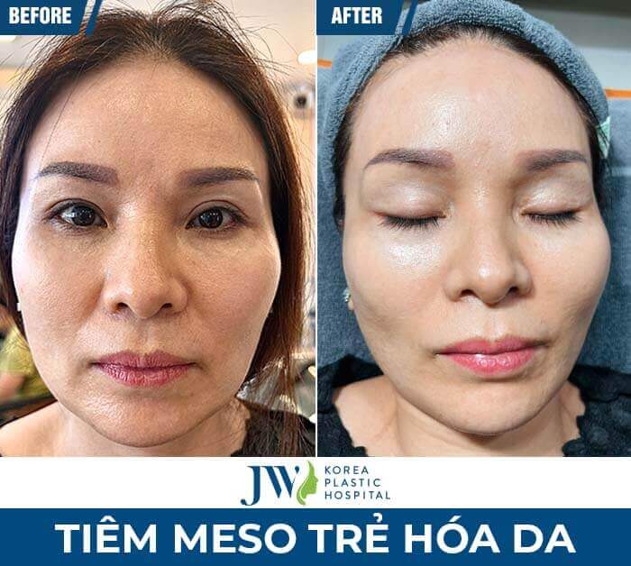 meso-tre-hoa-da-jw
