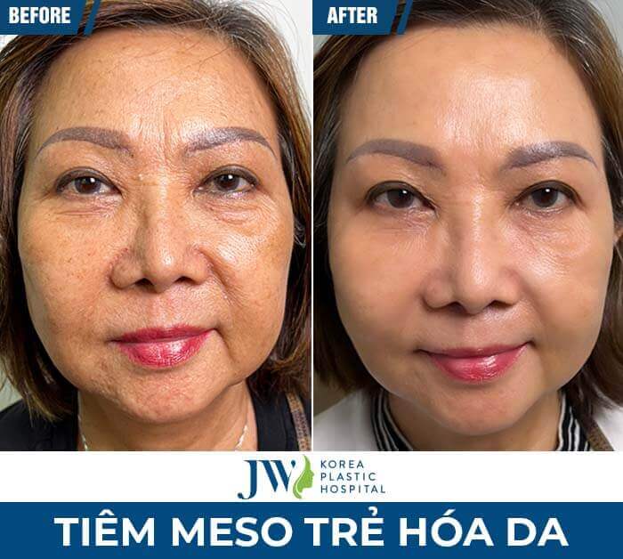 meso-tre-hoa-da-jw-3