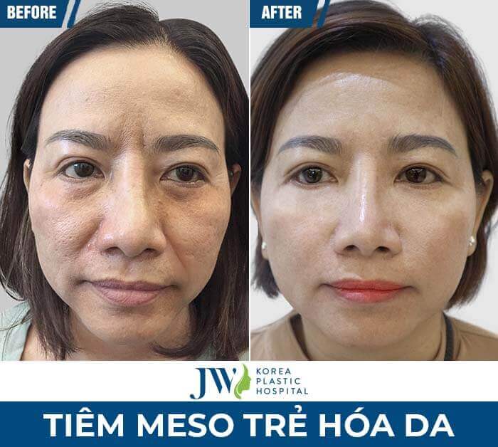 meso-tre-hoa-da-jw