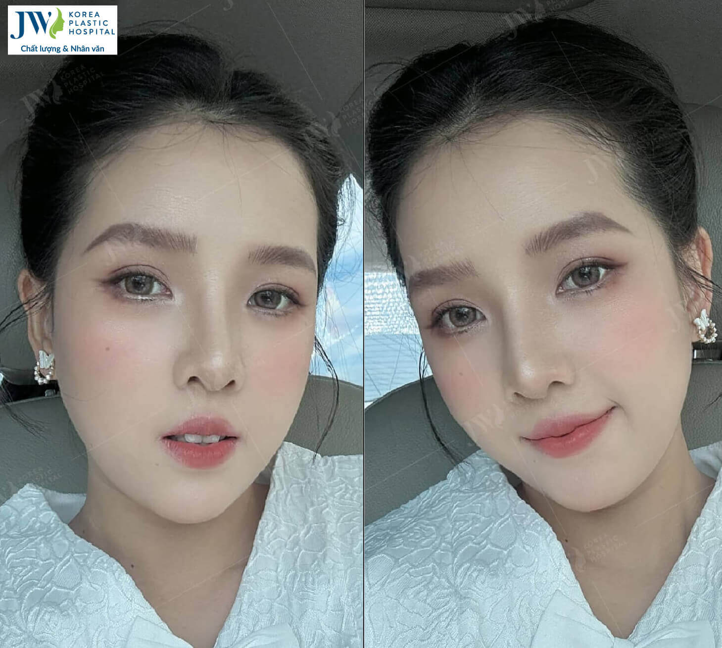 phẫu thuật hàm hô